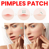 Star Colored Acne Stickers Repair Acne Pits & Marks Fade Acne Spots Blemishes Cover Acne Pimples